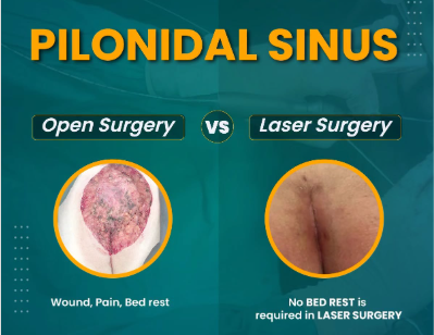 Pilonidal Sinus Surgery Pilonidal Sinus Surgery